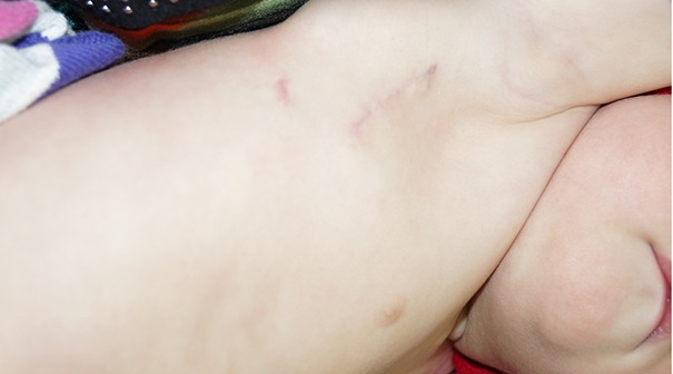 Фото ребенка через 6 месяцев после операции